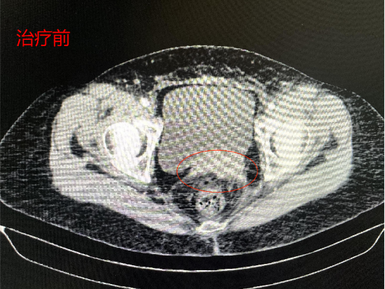 宮頸癌復(fù)發(fā)腎功能受影響放粒子加介入2個(gè)月重燃希望