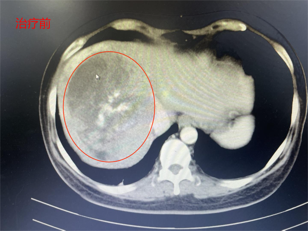 【肝癌巨型腫瘤】甲胎蛋白值高達(dá)11萬(wàn)，介入7個(gè)療程，甲胎蛋白降至32