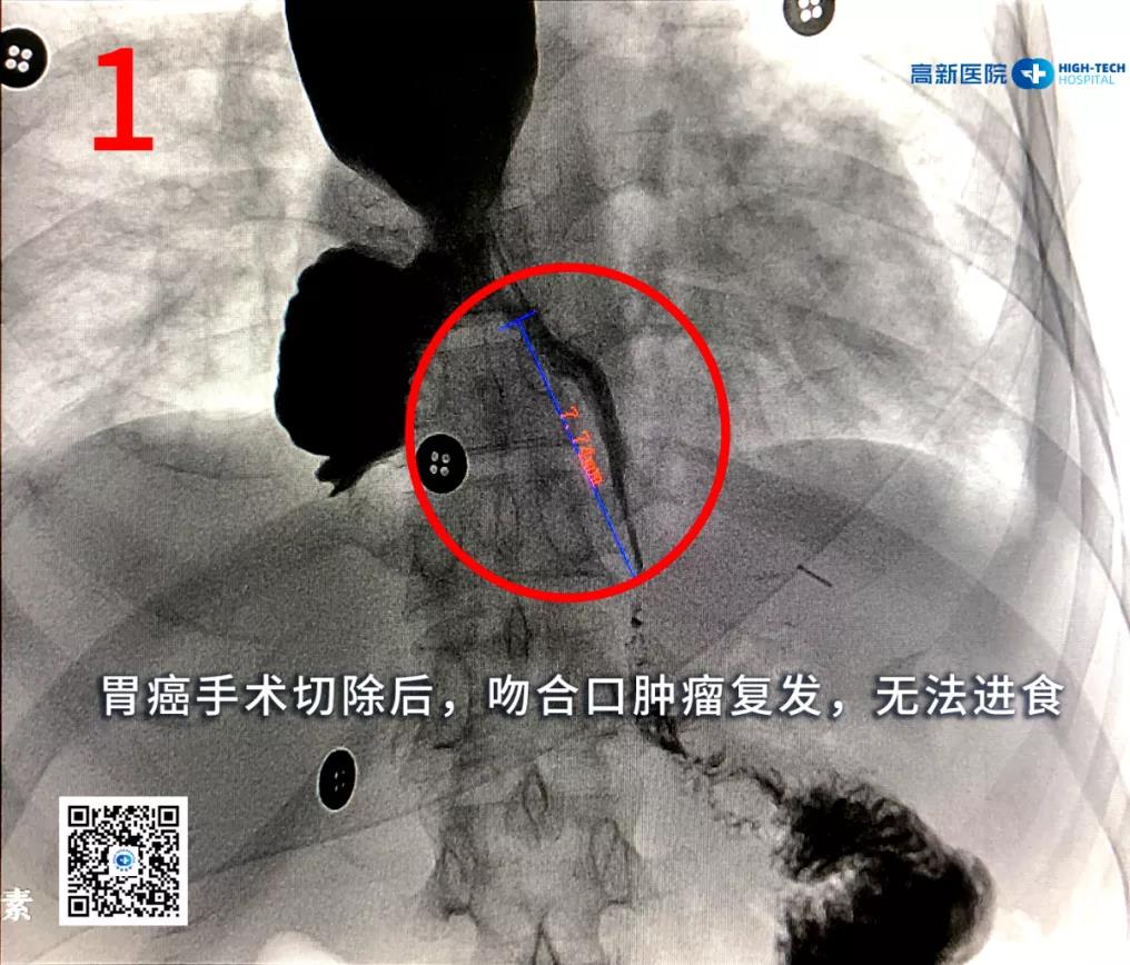 【胃癌】一位胃癌晚期患者從命懸一線(xiàn)到正常生活，幸運(yùn)絕非偶然！